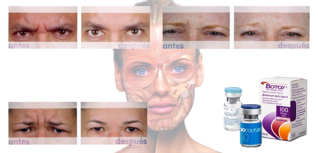 Resultado de imagen para toxina botulinica
