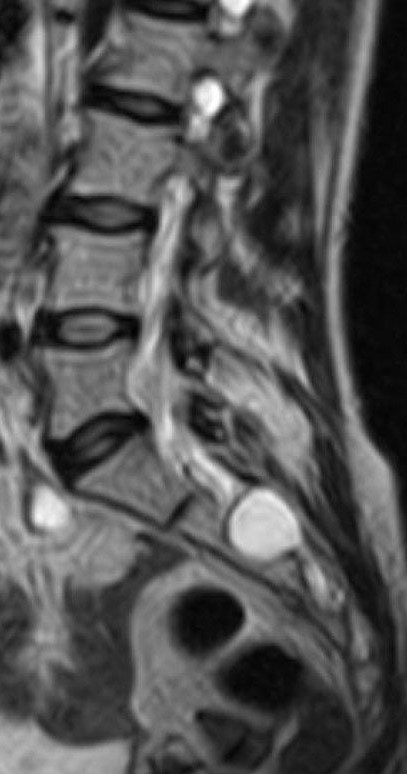 Resultado de imagen de quistes de tarlov