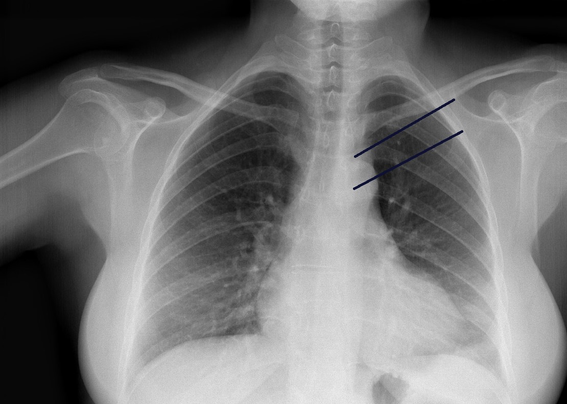 Tietze Syndrom Schwellung Brustbein Schlüsselbein elblogdeldolor.com